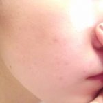 思春期にニキビが多い理由