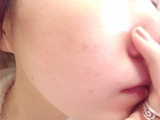 中学生のニキビ